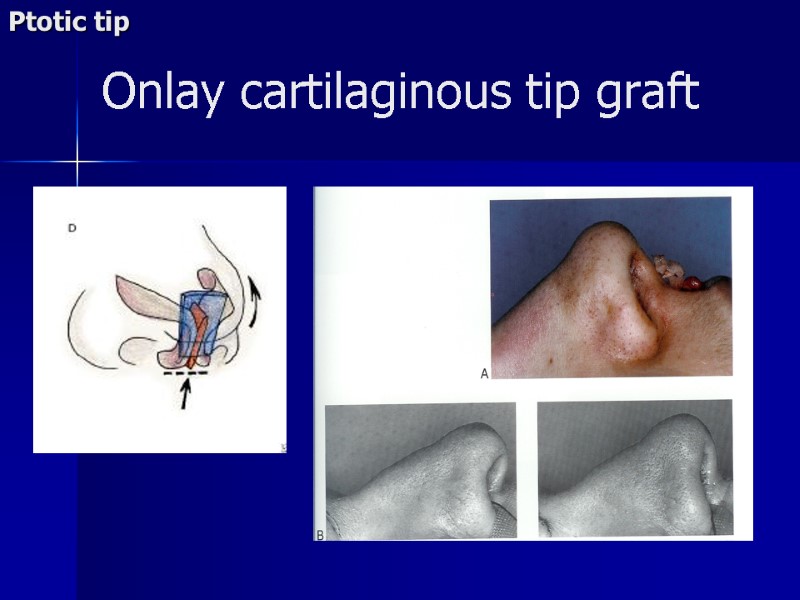 Onlay cartilaginous tip graft Ptotic tip